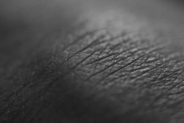 Photo dermographism skin marks